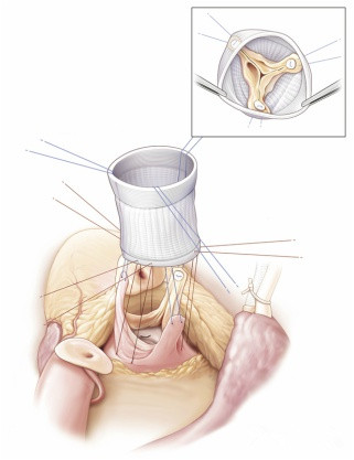 朱丹教授心脏瓣膜病外科治疗的修复与置换之争