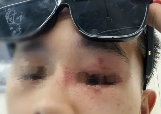 近期多人中招！河南一医院连收十几例患者，有人角膜受损，很多人第一反应就错了