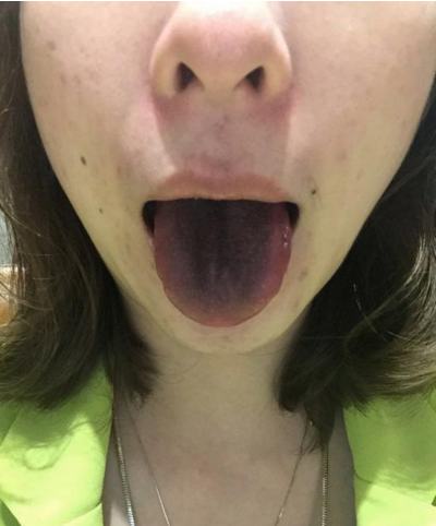 近日,苏州的一位女士在吃火锅时发现,自己的舌头全部都变黑了.