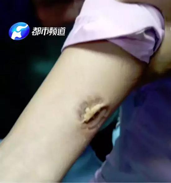 新乡女护士照顾病人被咬忍痛3分钟手臂留下2排牙印