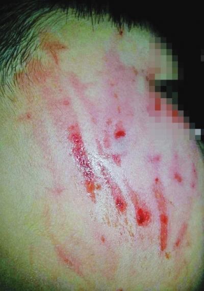 汝州幼儿园孩子抓自己一脸血家长质疑老师未制止