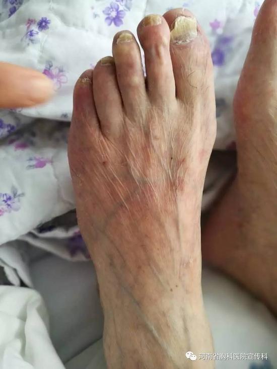 术后老人左脚趾呈自然粉色