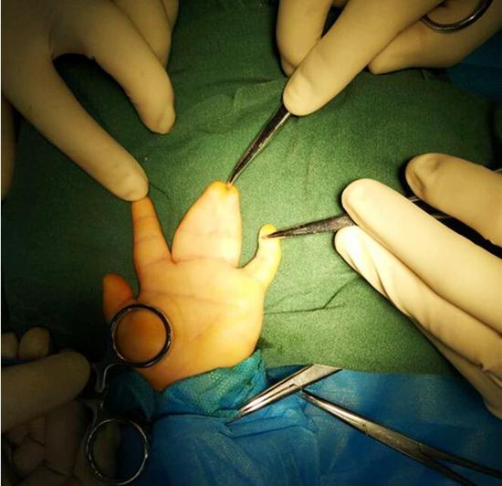 1岁时在一家医院做了右手手指分离术,但手术情况和术后康复情况并不