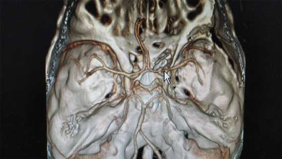 术后颅脑ct血管造影成像