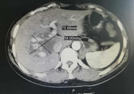 肝血管瘤b超图片