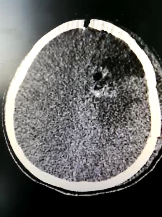 不食不休奋战14个小时,为13岁少年打赢"脑癌攻坚战"