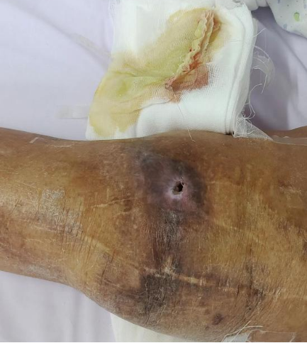 患者曲女士(化名),2017年因车祸致周身多处骨折,膝关节发生了开放性