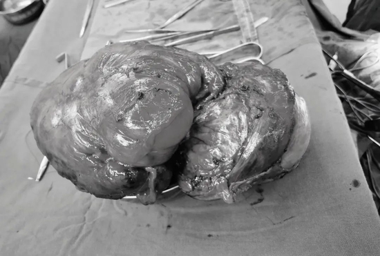 切除后完整的肿瘤