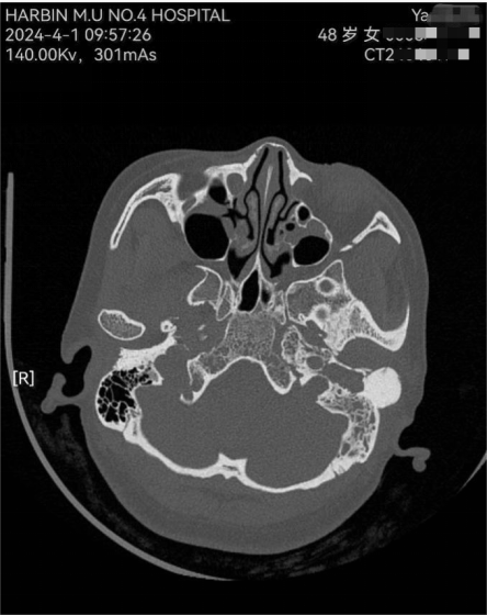 哈医大四院耳鼻咽喉头颈外科成功救治一例颞骨骨瘤伴耳部并发症患者