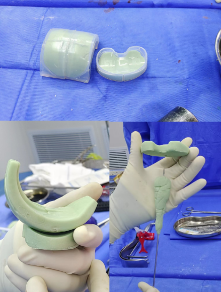 含有抗生素的骨水泥在定制的模具中塑型