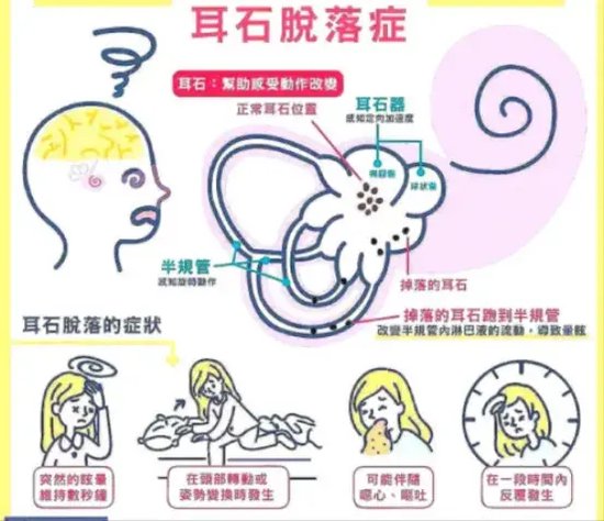 哈市二院神经内二科"旋转治疗" 让耳石症不再来!