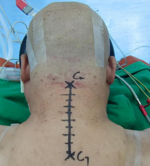 哈医大四院松北院区骨科医疗团队成功治疗一巨大间盘突出的脊髓型颈椎