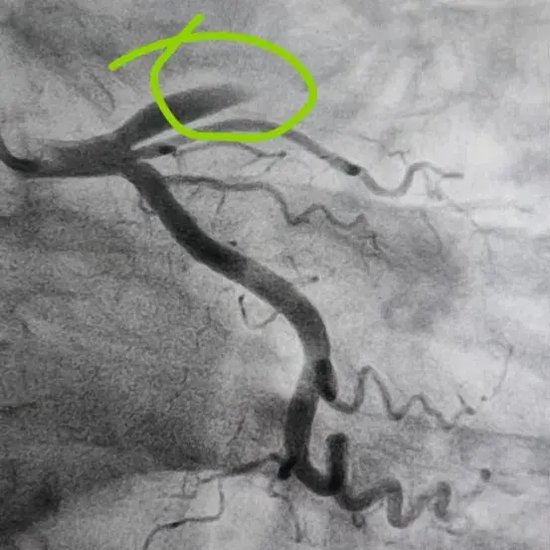 患者术前前降支闭塞