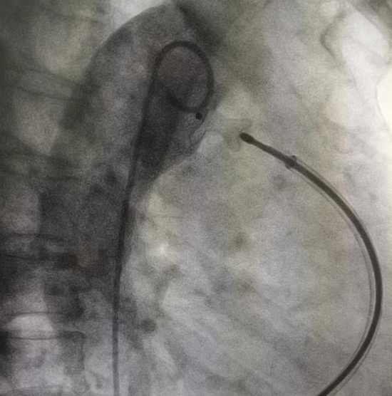术后经主动脉造影显示未闭的动脉导管已被封堵,分流消失,手术成功