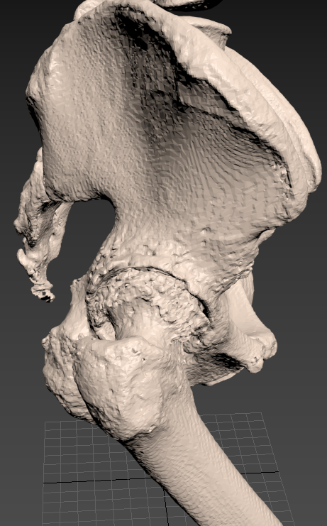 骨骼也能打印哈市二院成功将3d打印技术应用于人工全髋关节置换术