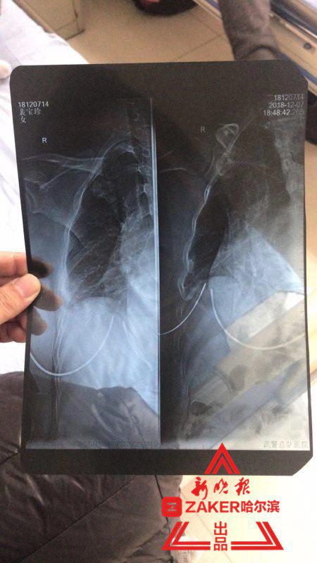 拍片显示三根肋骨骨折