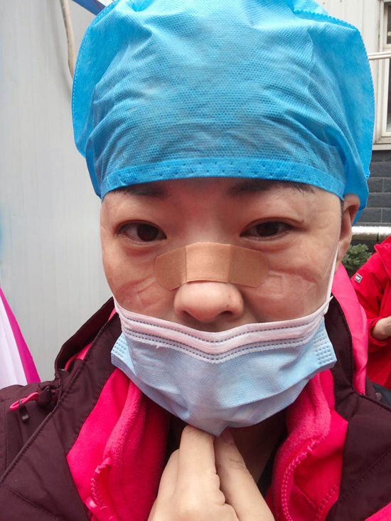 每天蒋琳琳的脸都被防护口罩勒出了深深的印子.