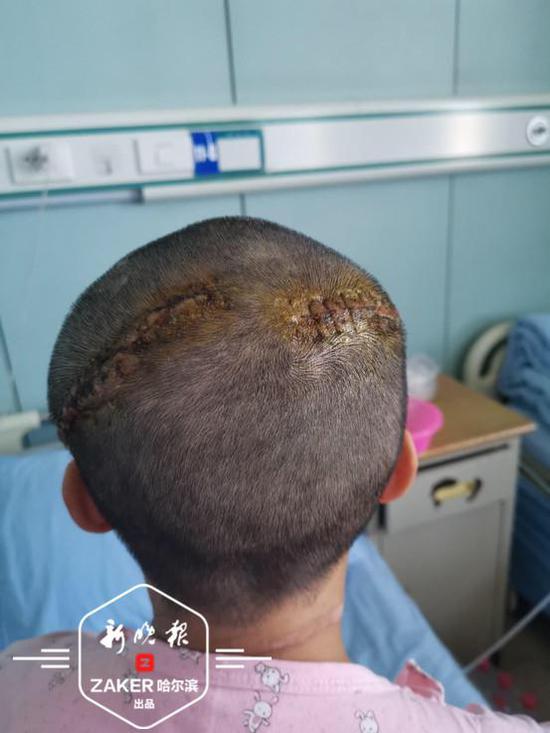 干这活别留长发女子头发卷入播种机整个头皮被掀开