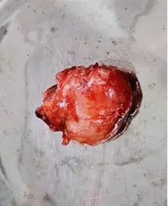 哈医大四院耳鼻喉科成功治疗一例罕见病木村病合并鼻息肉及鼻窦炎的