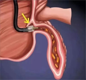 不开刀治疗阑尾炎哈医大四院消化内科成功完成一例内镜下逆行阑尾炎