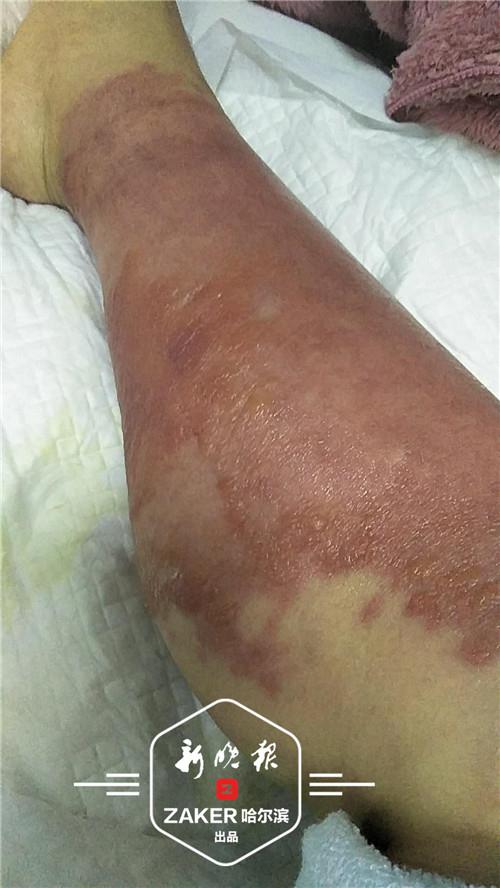 女子进山脚踝被不明毒虫咬伤 险些失去一条腿