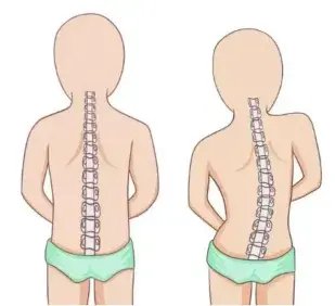哈医大四院儿童康复中心:别让脊柱走"弯"路