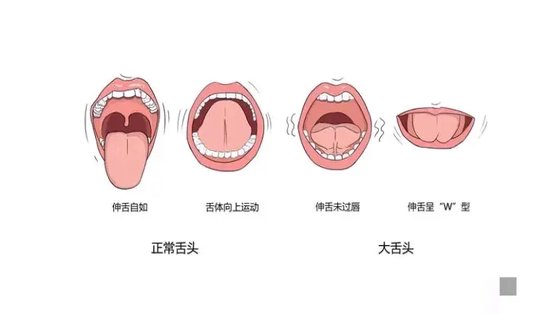 舌系带w形状图片图片