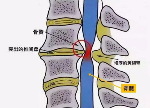 哈医大四院松北院区骨科医疗团队成功治疗一巨大间盘突出的脊髓型颈椎
