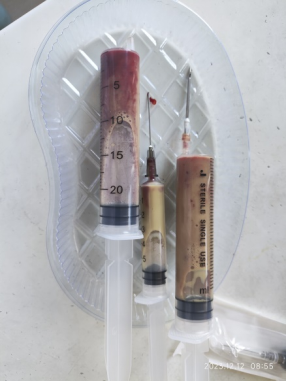 发现南南的"肿眼泡"很可能是感冒后急性鼻窦炎引起的眶周及眶内感染