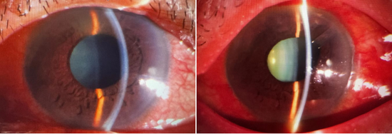 术前术后眼前节照相