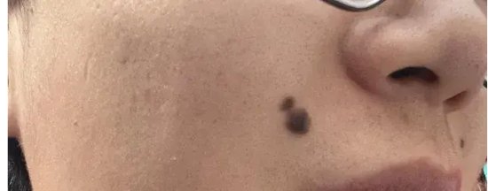 哈医大四院松北院区整形外科警惕皮肤恶性肿瘤从关注色素痣开始