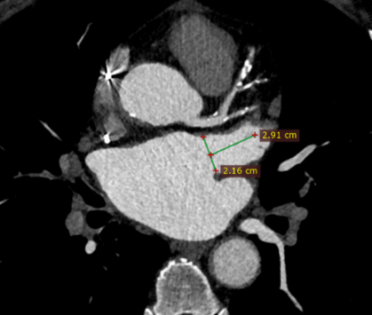 术前ct评估:心耳内确认无血栓,测量心耳开口21.6mm,深度29mm