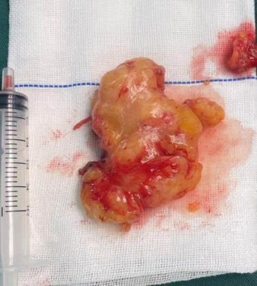 哈医大四院耳鼻咽喉头颈外科成功完成内镜辅助下咽旁间隙巨大肿瘤切除