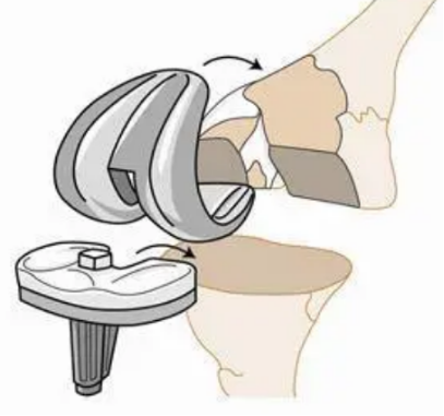 哈医大四院松北院区骨科医疗团队成功完成一例重度膝关节置换术后感染