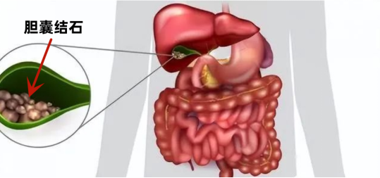 图一:胆囊位置示意图