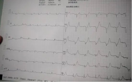 二医院联合医联体单位哈尔滨市民仁医院携手成功挽救两名危重心梗患者