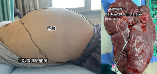 戈谢病患者脾脏的质地不同于正常人的脾脏,表现为既没有弹性又没有