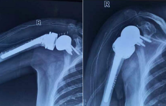 新技术——哈医大一院群力骨科完成全省首例全肩关节置换