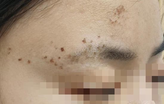 大四院松北院区皮肤科团队应用调q激光治疗仪精准治愈患者多年咖啡斑