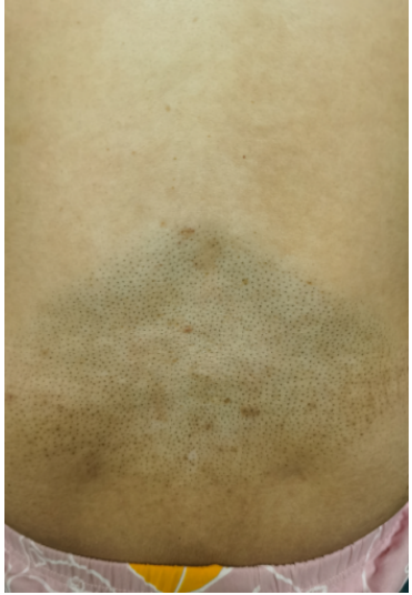 腰骶部皮肤毛发分布异常