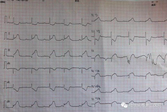 心电图显示急性下壁,右室心肌梗死伴iii度房室传导阻滞