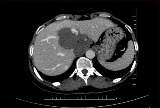 哈医大一院成功切除高风险的肝尾状叶巨大血管瘤
