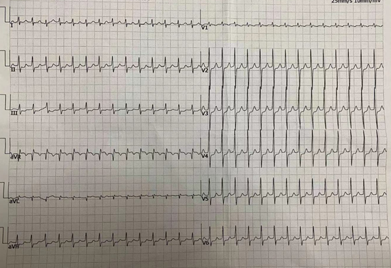 图片患者发作室上速时心电图,心率达190次/分