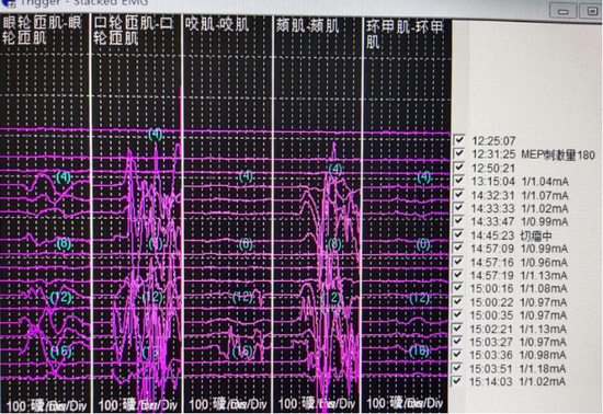 哈医大四院在神经电生理监测下切除听神经瘤
