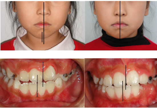 下图为早期矫治前后面型和口内像对比,可以看到矫治后的患儿面型左右