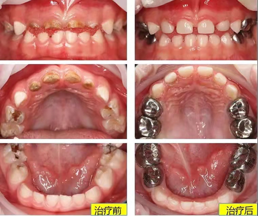 哈医大四院儿童口腔科专家:预成冠——儿童乳牙的"保护伞"