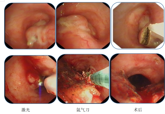 哈医大一院群力呼吸内镜介入技术为高龄患者消除病痛