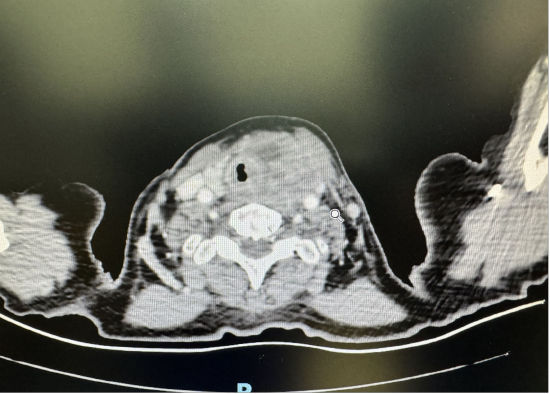 颈部增强ct甲状腺癌绝大多数为乳头状癌,是一种高发且治愈率很高的