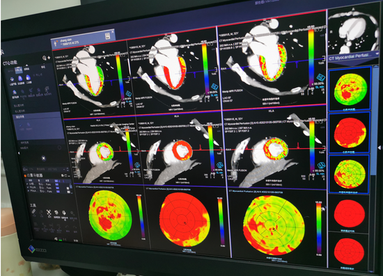 32岁小伙病因难寻 哈医大二院开展ct心肌负荷灌注检查 精准诊断心脏微