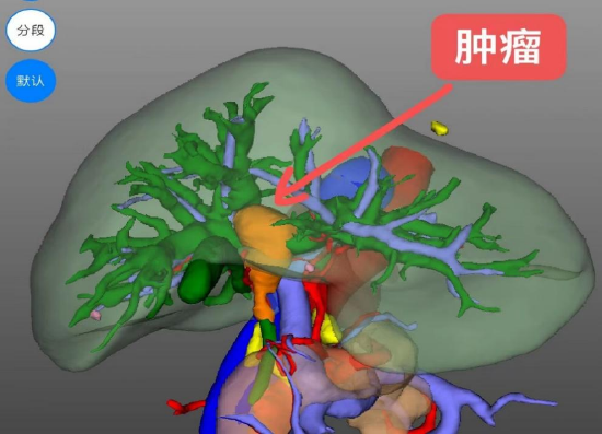 一院肝脏微创外科成功实施高难度机器人泰姬陵手术救治肝门胆管癌重患